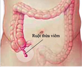 Đà Nẵng: Phẫu thuật thành công ca viêm ruột thừa có phủ tạng đảo ngược