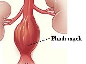 Điều trị phình động mạch chủ ngực bằng kỹ thuật mới