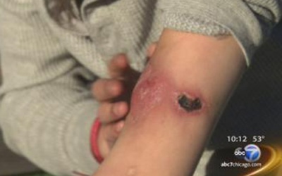 Mỹ: Bùng phát 'ma túy cá sấu' khiến cơ thể lở loét