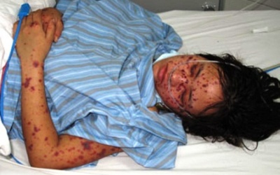 Viêm màng não mô cầu có thể giết người chỉ trong 1 ngày