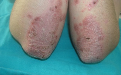 Tư vấn chăm sóc bệnh nhân vảy nến tại TP HCCM