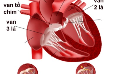 Hở van 3 lá có cần phẫu thuật?