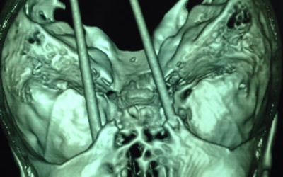 Phẫu thuật lấy đôi đũa đâm xuyên não bệnh nhân