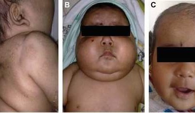 Glucocorticoid - con dao 2 lưỡi