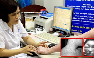 Viêm da tiếp xúc, coi chừng nhập viện