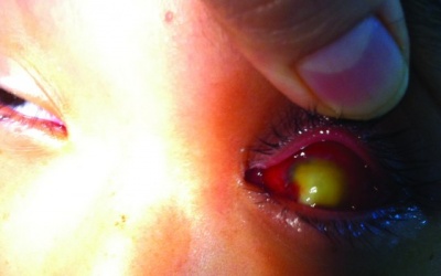 Mất mắt vì đắp lá dâm bụt