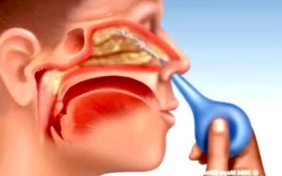 Nasacort 24HR được sử dụng trong điều trị dị ứng mũi