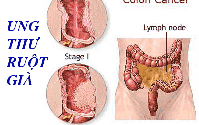 Phát hiện sớm để trị dứt điểm ung thư ruột già