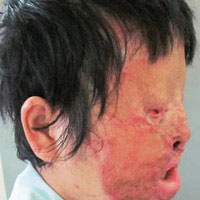 Tự hủy dung nhan vì lột da bằng axit