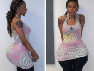 Mỹ bỏ tù bác sĩ thẩm mỹ bơm mông bằng... cao su