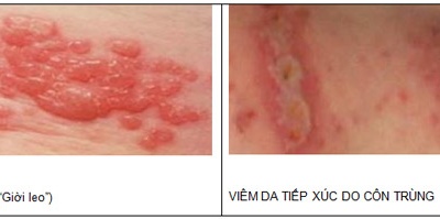 Phân biệt viêm da côn trùng và giời leo?