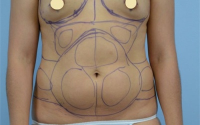 Cận cảnh một ca nâng ngực bằng mỡ thừa