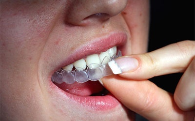 Thuốc tẩy trắng răng, 'tẩy' luôn cả răng