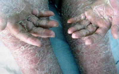 Càng stress, 'vảy nến' càng tăng nặng