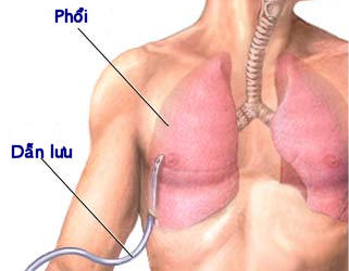 Adempas được sử dụng điều trị tăng áp lực động mạch phổi