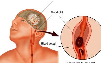 Tai biến mạch máu não: Những điều cần biết