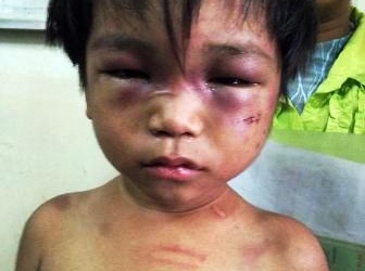 Cháu bé 3 tuổi bị bạo hành được mẹ đưa đi trốn?