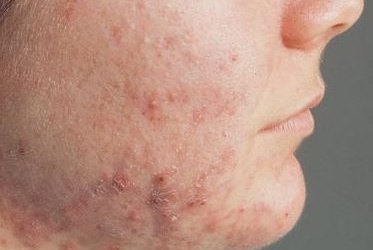 Chết vì thuốc trị mụn?