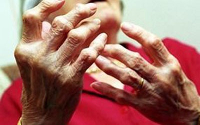 Tàn phế vì viêm khớp dạng thấp