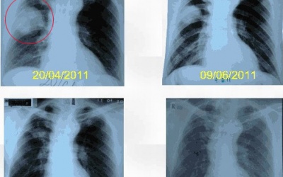 Tín hiệu khả quan từ kỹ thuật đốt u phổi bằng sóng cao tần