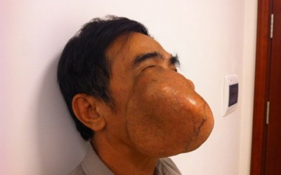 Cắt thành công khối u men răng khổng lồ