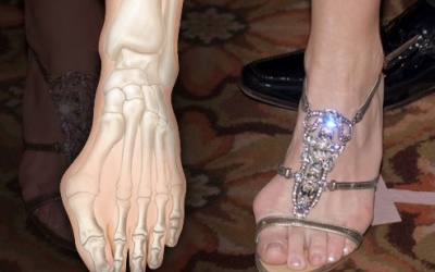 Biến dạng xương chân vì... dáng vẻ 'yêu kiều'