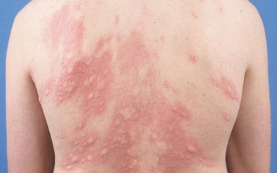 Nổi mề đay không rõ nguyên nhân