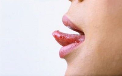 Lưỡi rát là bệnh gì?