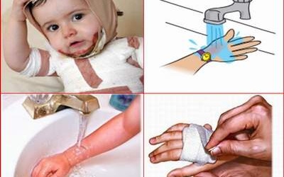 Khi trẻ bỏng gas, xử trí ban đầu là quan trọng nhất