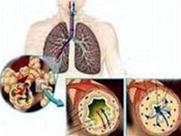 Việt Nam có 9 triệu người mắc phổi tắc nghẽn và hen phế quản