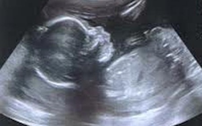 Thai nhi chào đời sau 3 tháng trong bụng mẹ chết lâm sàng