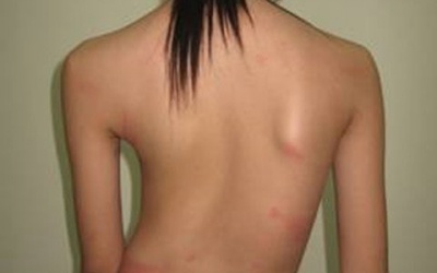 Phòng tránh cong vẹo cột sống cho con yêu