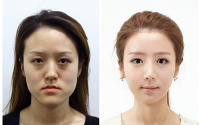 Sốc với 2 chị em song sinh sau 'dao kéo'