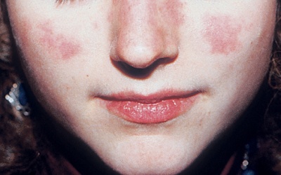 Thuốc cá thể hóa - hướng tiếp cận mới với bệnh Lupus