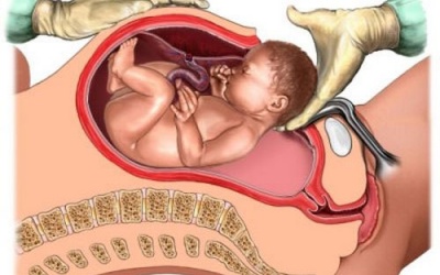 Mổ đẻ không làm giảm nguy cơ bại não