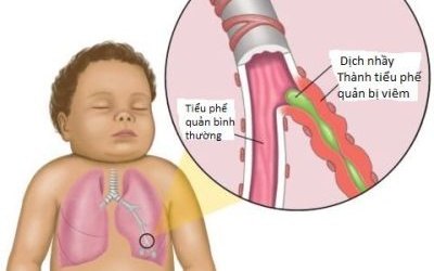 Viêm phế quản cấp có phải nhập viện không?