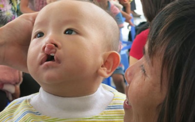 168 trẻ em dân tộc ở Hà Giang được phẫu thuật dị tật miễn phí