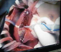 Việt Nam dự Hội thảo khu vực về cấy ghép gan và tủy