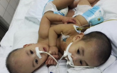 Tách rời hai bé trai dính nhau phức tạp