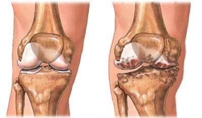 Chủ động với các bệnh cơ xương khớp