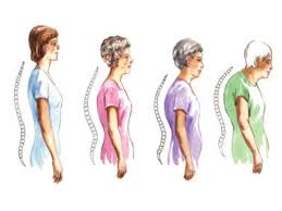 Hiểu đúng để phòng ngừa bệnh xốp xương