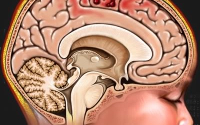 Cứu sống người bị khối u 'ăn' sọ