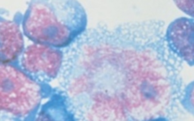 Phát hiện chủng HIV mới chuyển nhanh thành AIDS