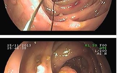 Nội soi cắt gần 40 u lành ở ruột già