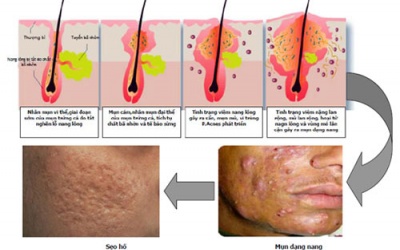 Để trị trứng cá an toàn với isotretinoin