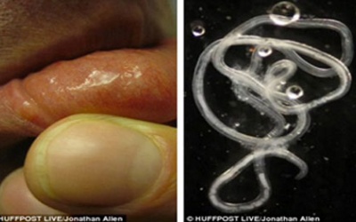 Ấu trùng giun di chuyển dưới da do nhiễm từ động vật