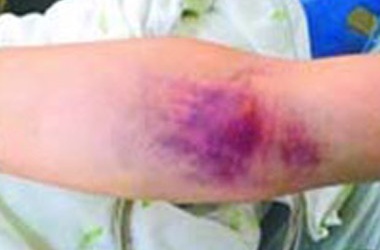 Bệnh nhi chảy máu chân răng kéo dài do ngộ độc thuốc diệt chuột