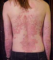 Điều trị vẩy nến mạn tính toàn thân bằng cách nào?