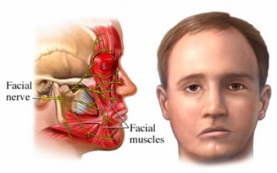 Phòng tránh liệt mặt mùa lạnh