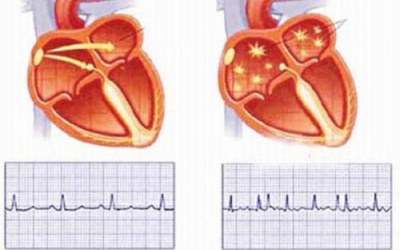Tổn thương mắt và thận gây rung nhĩ